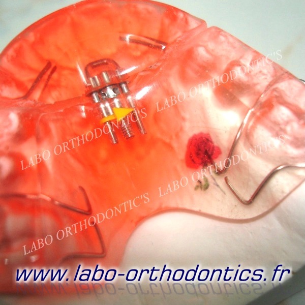 Orthodontie : la mobile | Laboratoire Orthodontic's